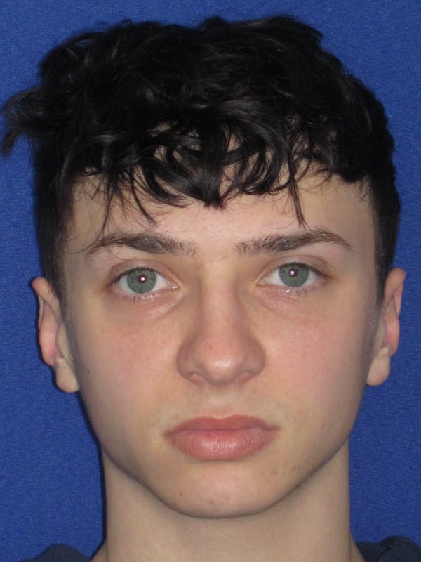 Rhinoplasty Before & After Gallery - Patient 144022 - Image 3