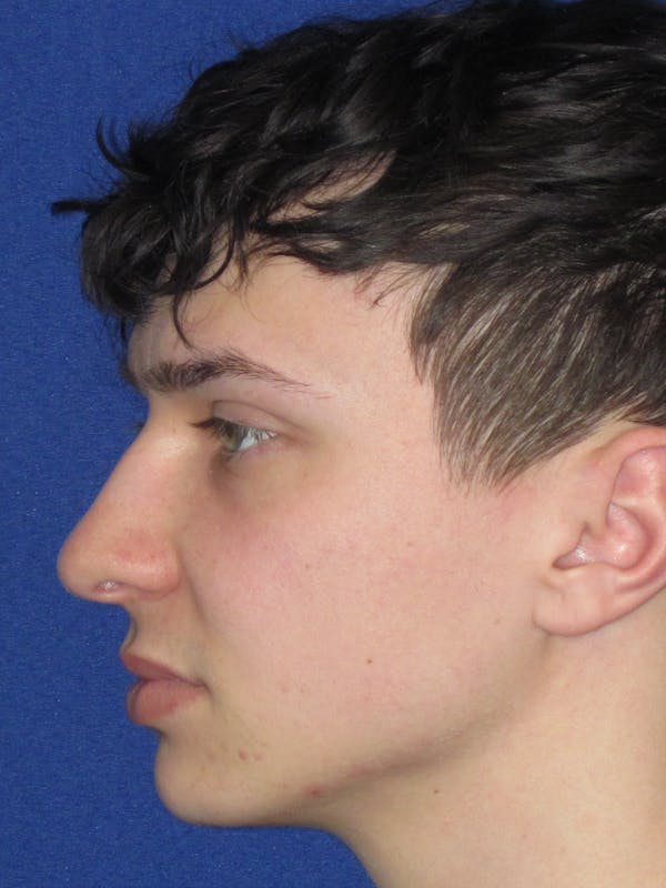 Rhinoplasty Before & After Gallery - Patient 144022 - Image 11