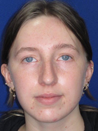 Rhinoplasty Before & After Gallery - Patient 139403 - Image 1