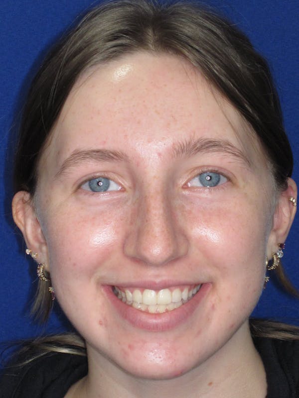 Rhinoplasty Before & After Gallery - Patient 139403 - Image 3