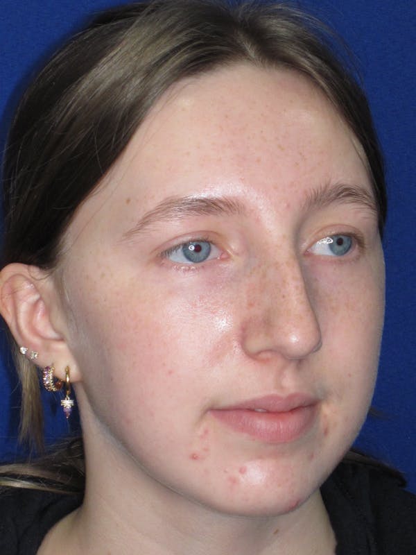 Rhinoplasty Before & After Gallery - Patient 139403 - Image 5