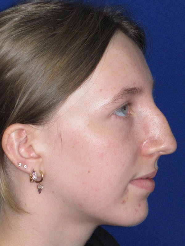 Rhinoplasty Before & After Gallery - Patient 139403 - Image 7