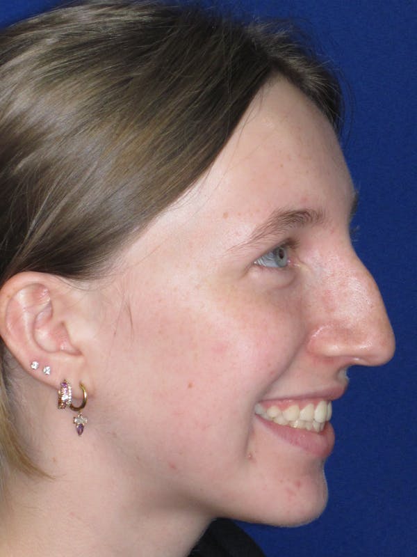 Rhinoplasty Before & After Gallery - Patient 139403 - Image 9