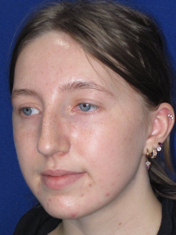Rhinoplasty Before & After Gallery - Patient 139403 - Image 11