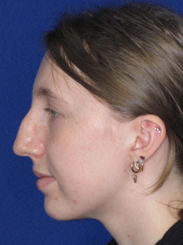 Rhinoplasty Before & After Gallery - Patient 139403 - Image 13