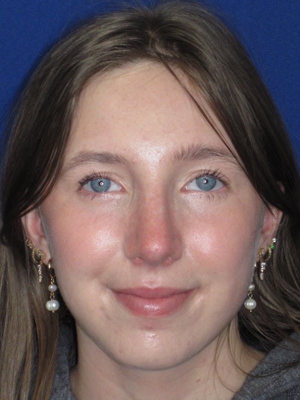 Rhinoplasty Before & After Gallery - Patient 139403 - Image 4