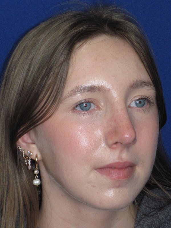 Rhinoplasty Before & After Gallery - Patient 139403 - Image 6