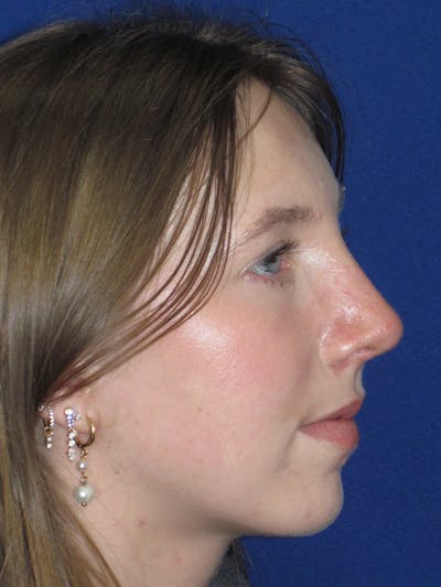 Rhinoplasty Before & After Gallery - Patient 139403 - Image 8