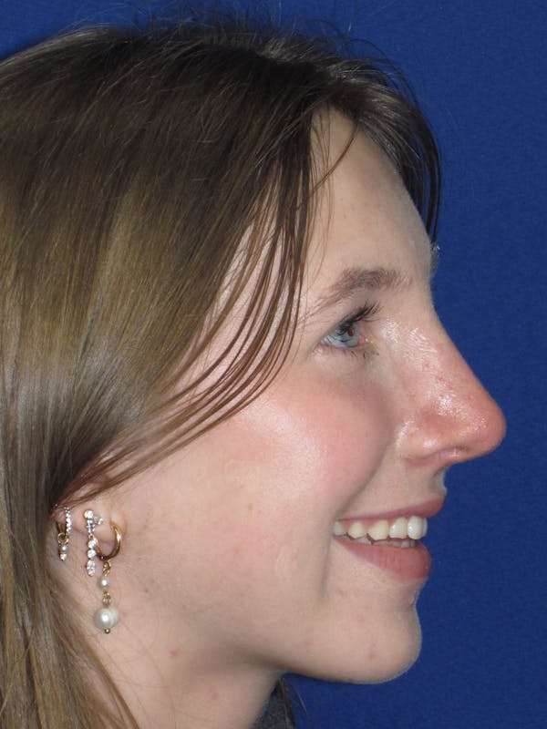 Rhinoplasty Before & After Gallery - Patient 139403 - Image 10