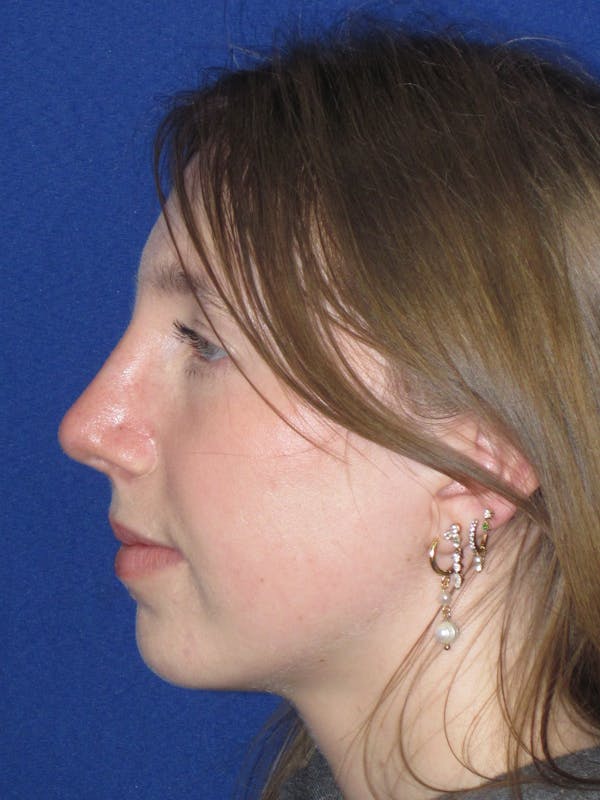 Rhinoplasty Before & After Gallery - Patient 139403 - Image 14