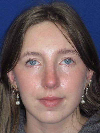 Rhinoplasty Before & After Gallery - Patient 139403 - Image 2
