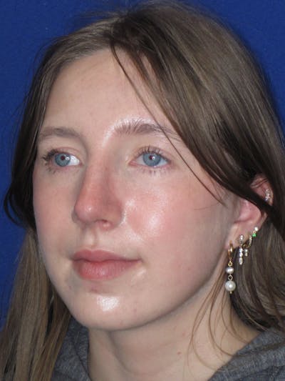 Rhinoplasty Before & After Gallery - Patient 139403 - Image 12