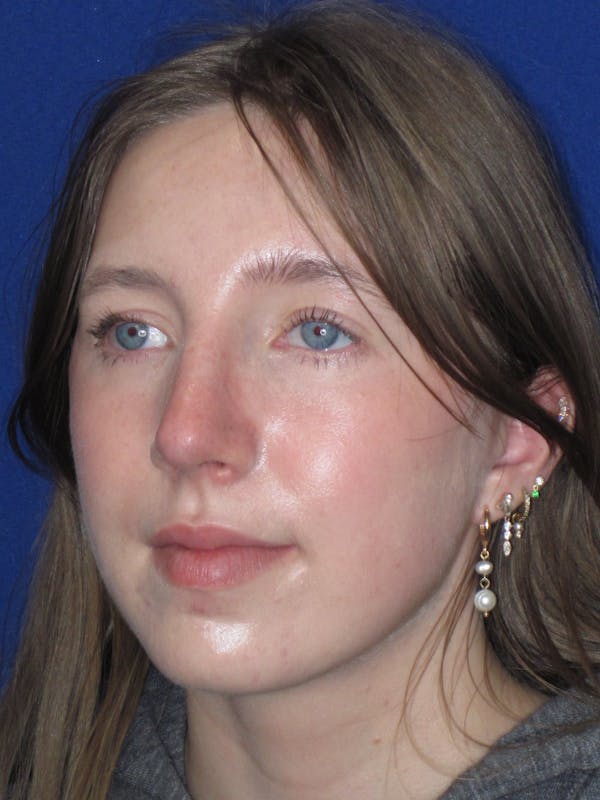 Rhinoplasty Before & After Gallery - Patient 139403 - Image 12