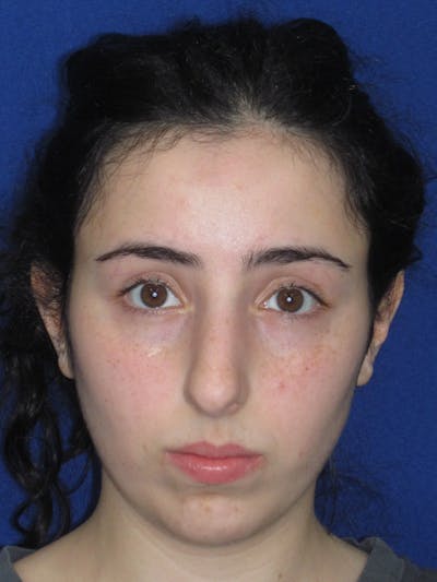 Rhinoplasty Before & After Gallery - Patient 392274 - Image 1