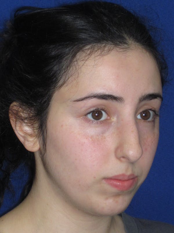 Rhinoplasty Before & After Gallery - Patient 392274 - Image 3