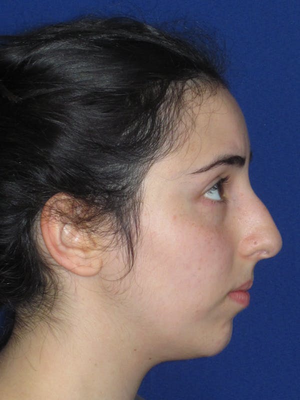 Rhinoplasty Before & After Gallery - Patient 392274 - Image 5