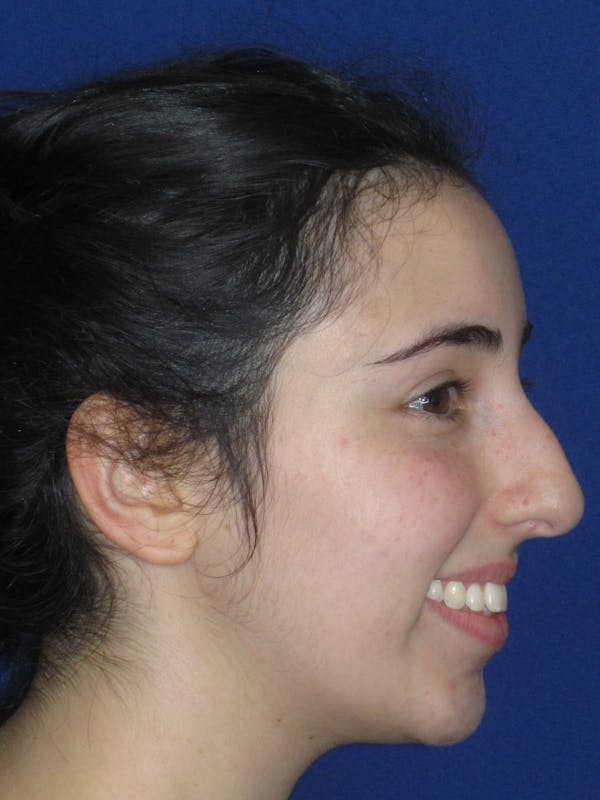 Rhinoplasty Before & After Gallery - Patient 392274 - Image 7