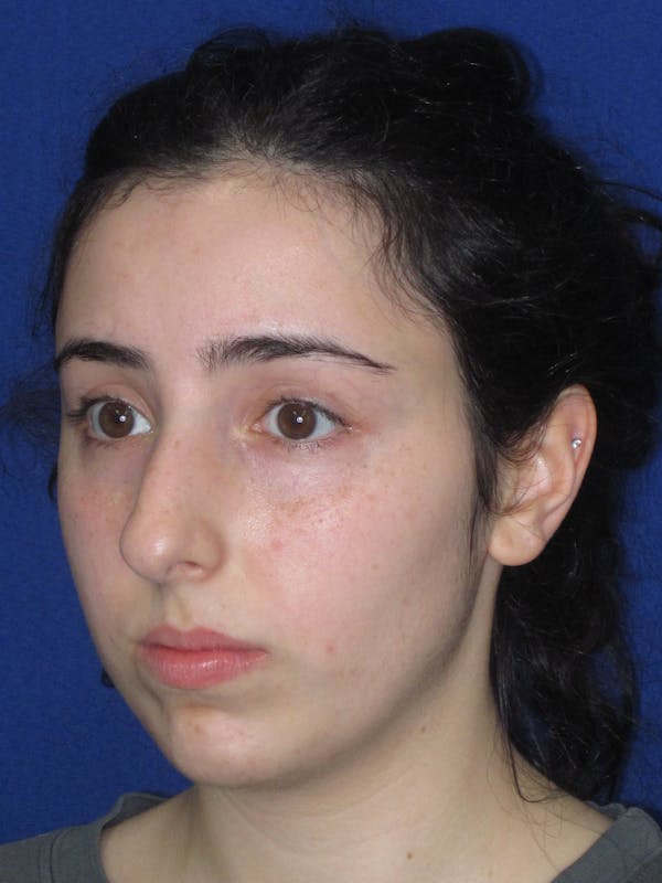 Rhinoplasty Before & After Gallery - Patient 392274 - Image 9