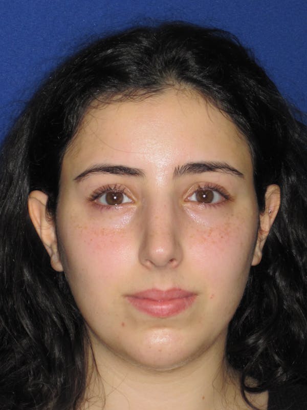 Rhinoplasty Before & After Gallery - Patient 392274 - Image 2