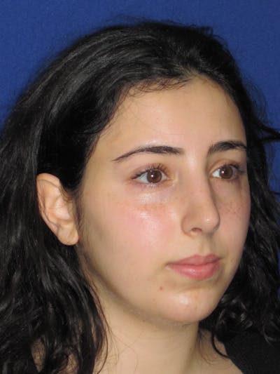Rhinoplasty Before & After Gallery - Patient 392274 - Image 4