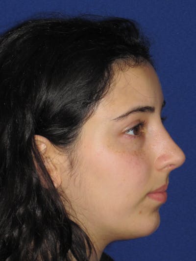 Rhinoplasty Before & After Gallery - Patient 392274 - Image 6