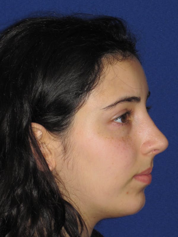 Rhinoplasty Before & After Gallery - Patient 392274 - Image 6