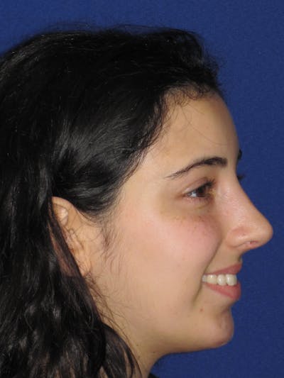 Rhinoplasty Before & After Gallery - Patient 392274 - Image 8
