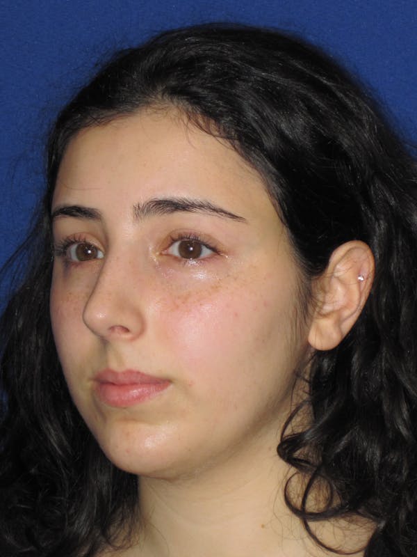 Rhinoplasty Before & After Gallery - Patient 392274 - Image 10