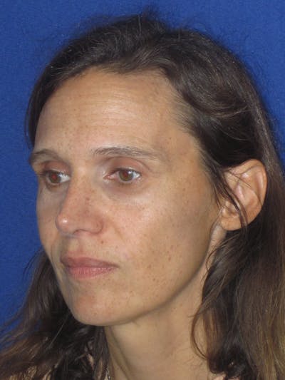 Rhinoplasty Before & After Gallery - Patient 343942 - Image 6