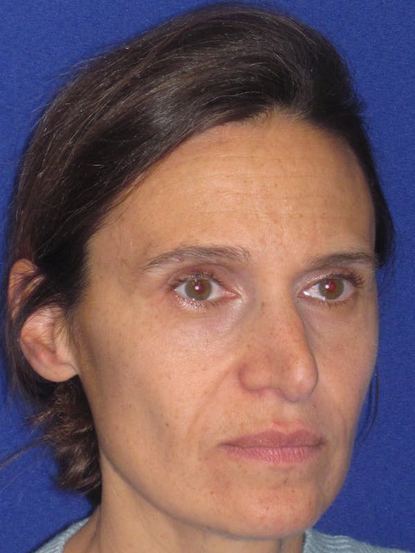 Rhinoplasty Before & After Gallery - Patient 343942 - Image 3