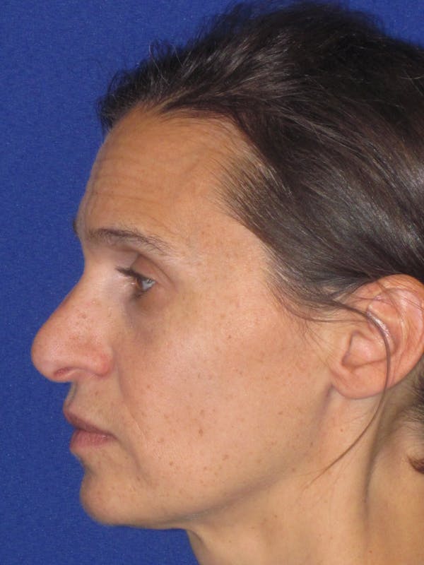 Rhinoplasty Before & After Gallery - Patient 343942 - Image 7