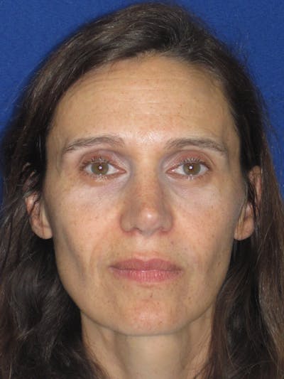 Rhinoplasty Before & After Gallery - Patient 343942 - Image 2