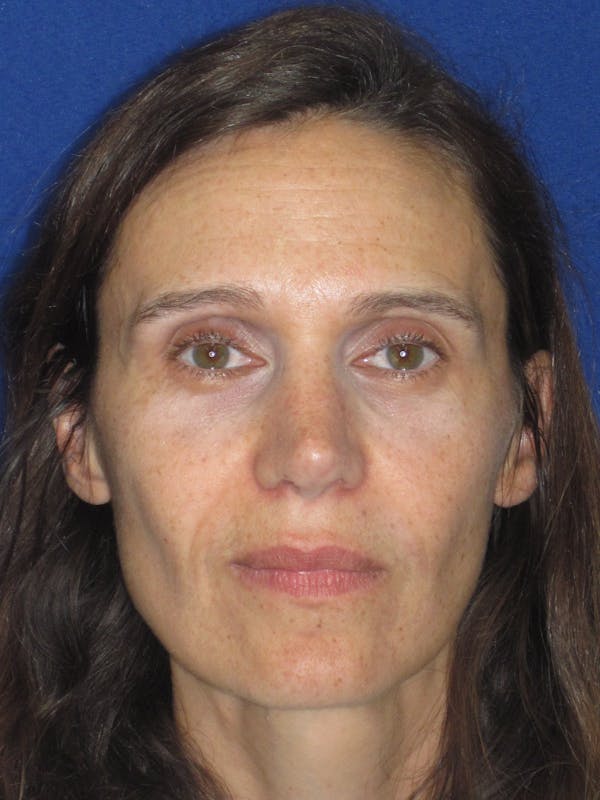 Rhinoplasty Before & After Gallery - Patient 343942 - Image 2