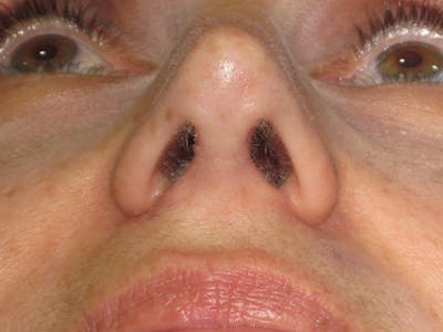 Rhinoplasty Before & After Gallery - Patient 343942 - Image 12