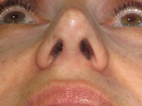 Rhinoplasty Before & After Gallery - Patient 343942 - Image 12