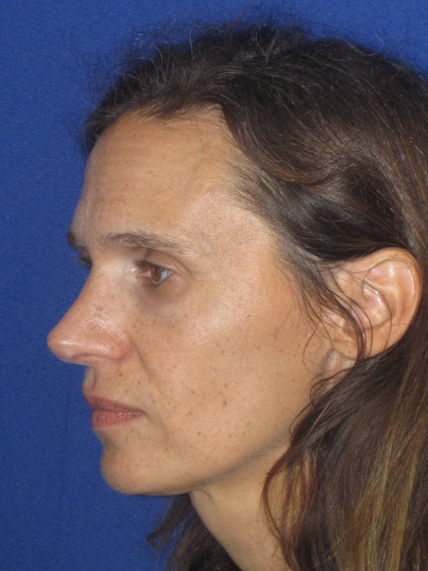 Rhinoplasty Before & After Gallery - Patient 343942 - Image 10