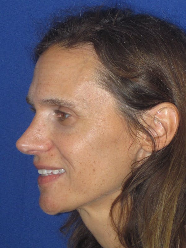 Rhinoplasty Before & After Gallery - Patient 343942 - Image 8