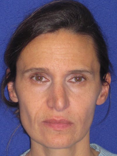 Rhinoplasty Before & After Gallery - Patient 343942 - Image 1