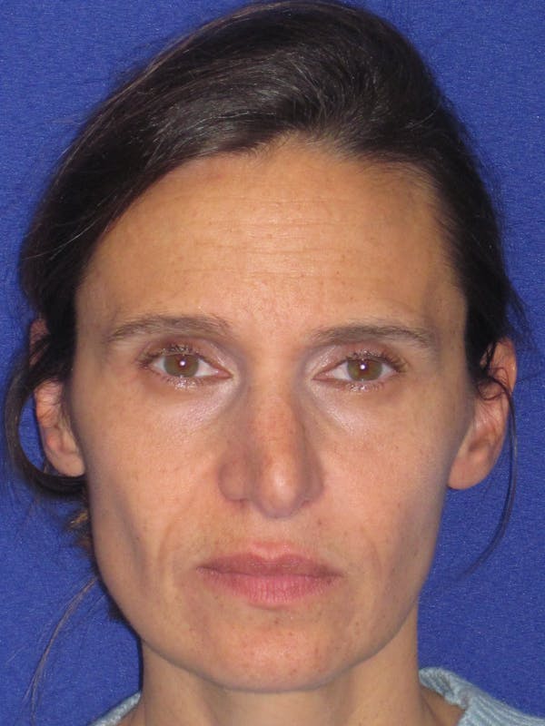 Rhinoplasty Before & After Gallery - Patient 343942 - Image 1