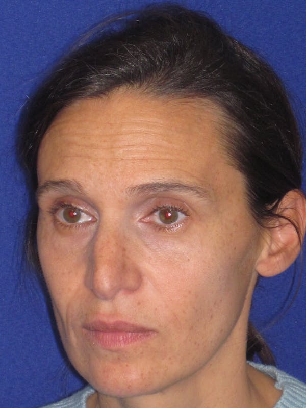 Rhinoplasty Before & After Gallery - Patient 343942 - Image 5