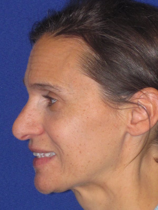 Rhinoplasty Before & After Gallery - Patient 343942 - Image 9