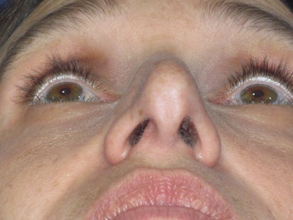 Rhinoplasty Before & After Gallery - Patient 343942 - Image 11