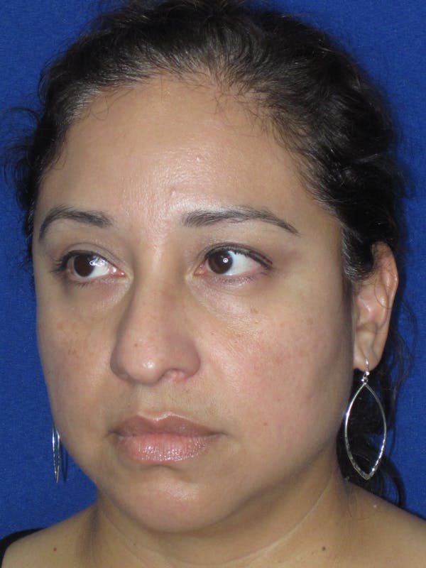 Rhinoplasty Before & After Gallery - Patient 391656 - Image 9