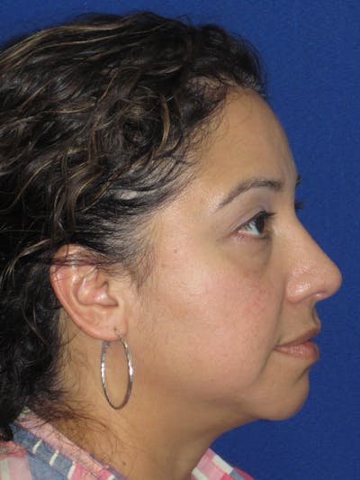 Rhinoplasty Before & After Gallery - Patient 391656 - Image 2