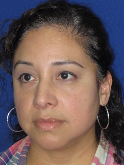 Rhinoplasty Before & After Gallery - Patient 391656 - Image 10