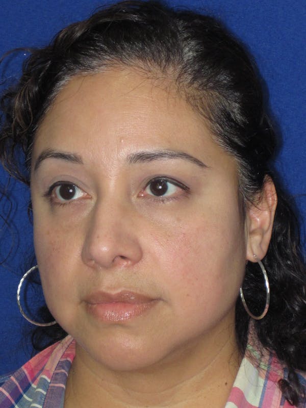 Rhinoplasty Before & After Gallery - Patient 391656 - Image 10
