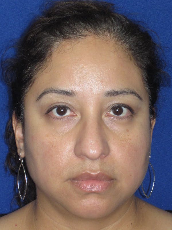 Rhinoplasty Before & After Gallery - Patient 391656 - Image 3