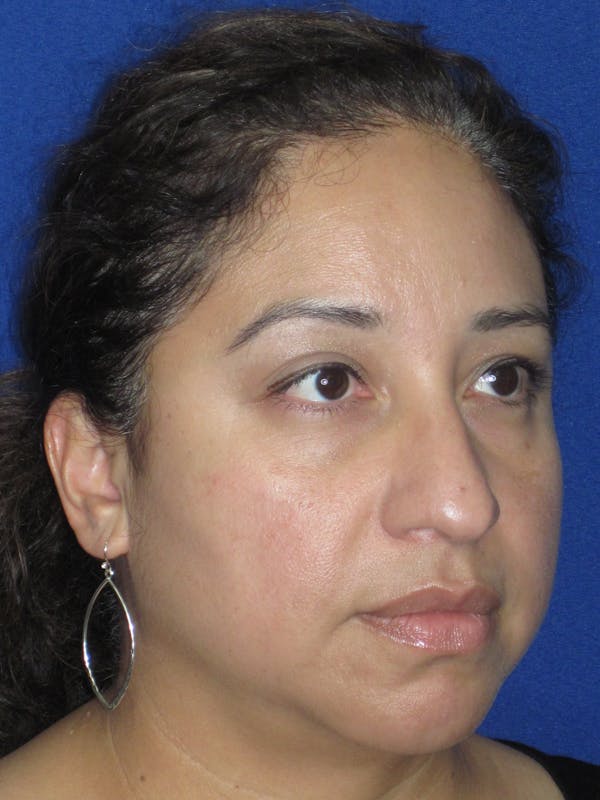 Rhinoplasty Before & After Gallery - Patient 391656 - Image 5