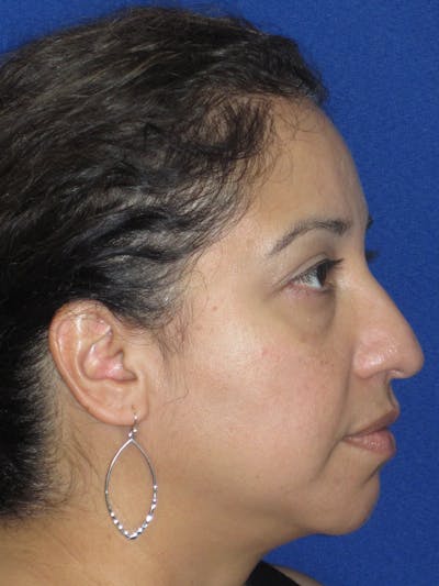 Rhinoplasty Before & After Gallery - Patient 391656 - Image 1