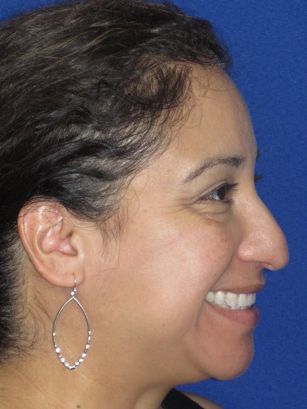 Rhinoplasty Before & After Gallery - Patient 391656 - Image 7